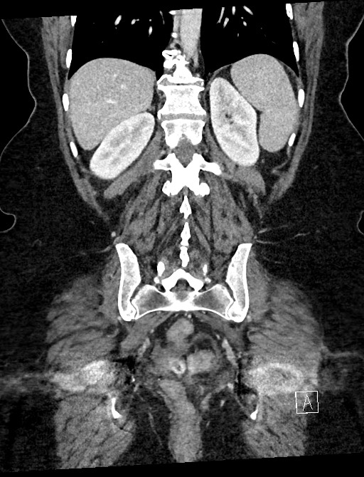 Closed loop small bowel obstruction - adhesions (Radiopaedia 59078-66369 B 92).jpg
