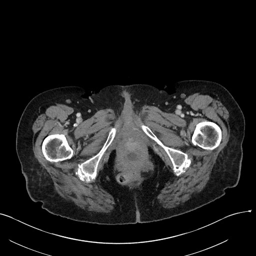 File:Closed loop small bowel obstruction - adhesions (Radiopaedia 59269-66611 Axial 128).jpg
