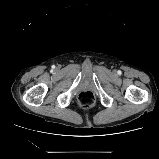 File:Closed loop small bowel obstruction - adhesive disease and hemorrhagic ischemia (Radiopaedia 86831-102990 A 185).jpg