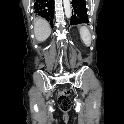 Closed loop small bowel obstruction - adhesive disease and hemorrhagic ischemia (Radiopaedia 86831-102990 B 102).jpg