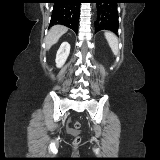 Closed loop small bowel obstruction - internal hernia (Radiopaedia 65402-74450 B 83).jpg