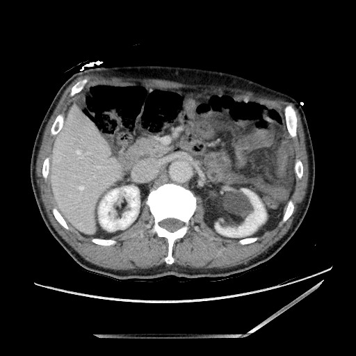 File:Closed loop small bowel obstruction - omental adhesion causing "internal hernia" (Radiopaedia 85129-100682 A 57).jpg