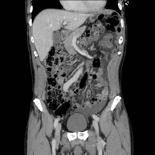 Closed loop small bowel obstruction - omental adhesion causing "internal hernia" (Radiopaedia 85129-100682 B 50).jpg