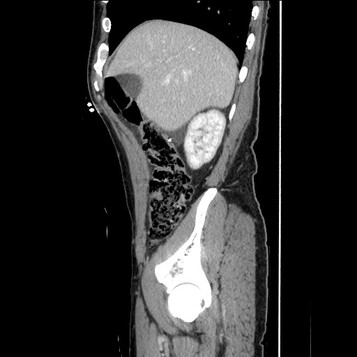 Closed loop small bowel obstruction - omental adhesion causing "internal hernia" (Radiopaedia 85129-100682 C 50).jpg