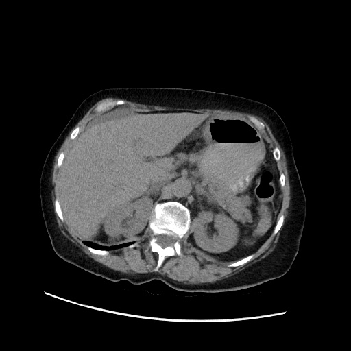 Closed loop small bowel obstruction due to adhesive band, with intramural hemorrhage and ischemia (Radiopaedia 83831-99017 Axial non-contrast 50).jpg