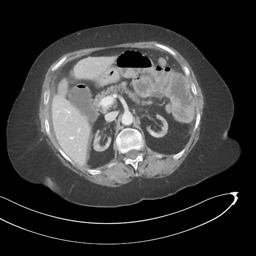 File:Closed loop small bowel obstruction due to adhesive bands - early and late images (Radiopaedia 83830-99014 C 131).png