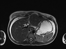 File:Closed loop small bowel obstruction in pregnancy (MRI) (Radiopaedia 87637-104031 Axial T2 16).jpg
