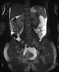 File:Closed loop small bowel obstruction in pregnancy (MRI) (Radiopaedia 87637-104031 Coronal T2 fat sat 38).jpg