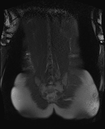 File:Closed loop small bowel obstruction in pregnancy (MRI) (Radiopaedia 87637-104031 Coronal T2 fat sat 47).jpg