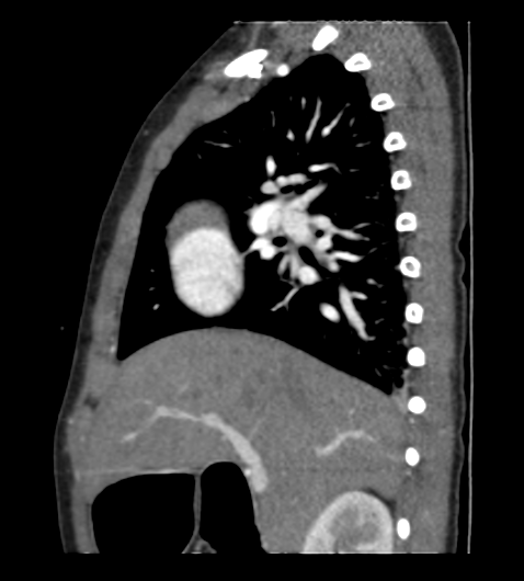 Coarctation of aorta (Radiopaedia 27427-27622 Sagittal C+ CTPA 35).png