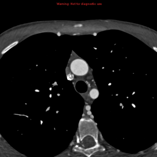 File:Coarctation of the aorta (Radiopaedia 12461-12697 A 92).jpg