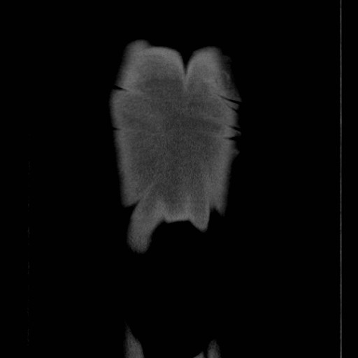 File:Coarctation of the aorta (Radiopaedia 17427-17116 A 2).jpg