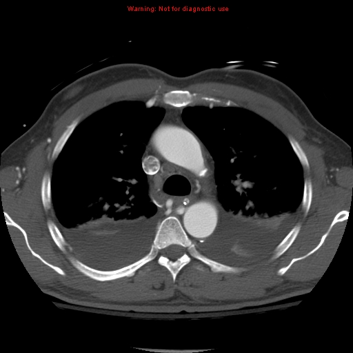 File:Coarctation of the aorta (Radiopaedia 8681-9490 B 24).jpg