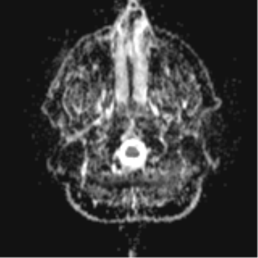 File:Colloid cyst (Radiopaedia 44510-48181 Axial ADC 2).png