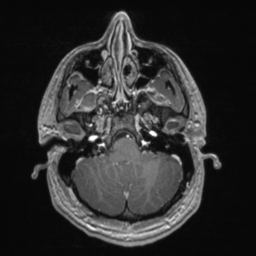 File:Colloid cyst (Radiopaedia 44510-48181 Axial T1 C+ 46).png
