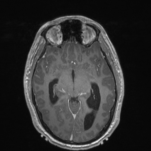 File:Colloid cyst (Radiopaedia 44510-48181 Axial T1 C+ 82).png