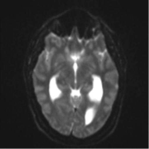 File:Colloid cyst (Radiopaedia 53164-59125 Axial DWI 12).png