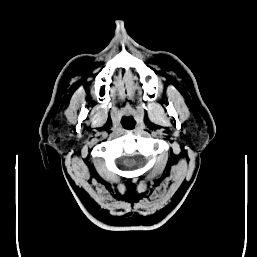 File:Colloid cyst (large) (Radiopaedia 34415-35734 Axial non-contrast 3).png