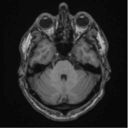 File:Colloid cyst of the third ventricle (Radiopaedia 86571-102662 Axial T1 24).png