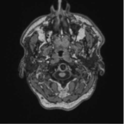 File:Colloid cyst of the third ventricle (Radiopaedia 86571-102662 Axial T1 4).png