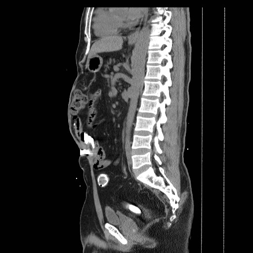 Colocutaneous fistula in Crohn's disease (Radiopaedia 29586-30093 F 20).jpg