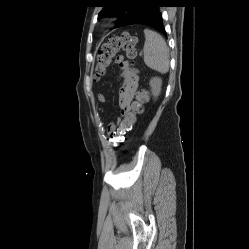 Colocutaneous fistula in Crohn's disease (Radiopaedia 29586-30093 F 47).jpg