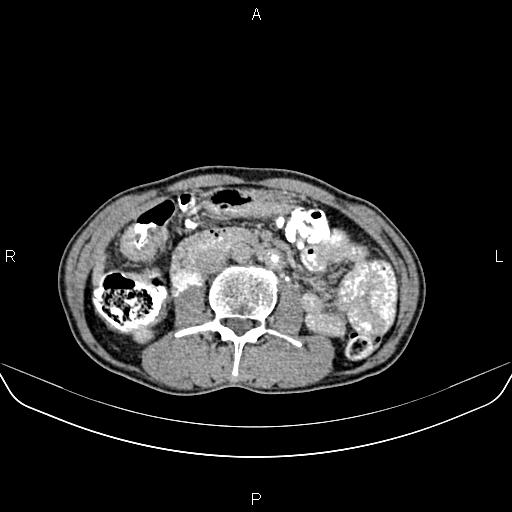 File:Colon adenocarcinoma - hepatic flexure (Radiopaedia 85635-101395 Axial C+ delayed 44).jpg