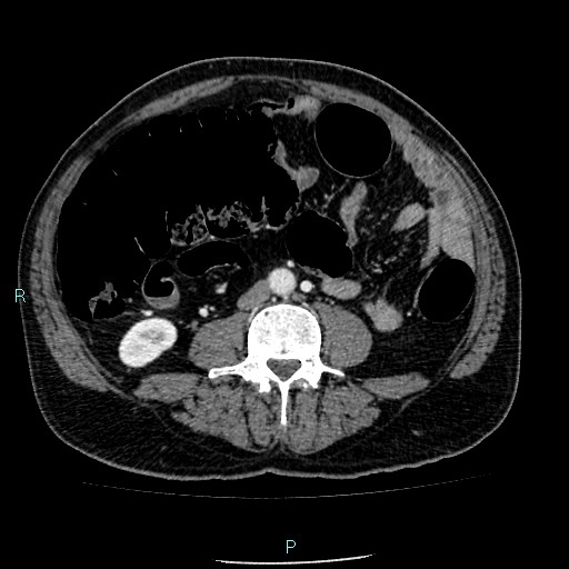 Colon adenocarcinoma with calcific liver metastasis (Radiopaedia 55745-62300 B 25).jpg