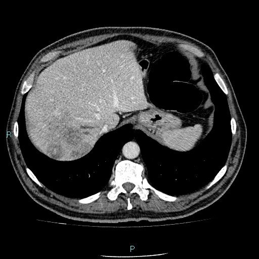 Colon adenocarcinoma with calcific liver metastasis (Radiopaedia 55745-62300 B 5).jpg