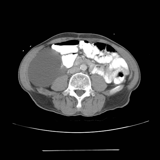 Colon cancer with calcified liver metastasis (Radiopaedia 74423-85307 A 43).jpg