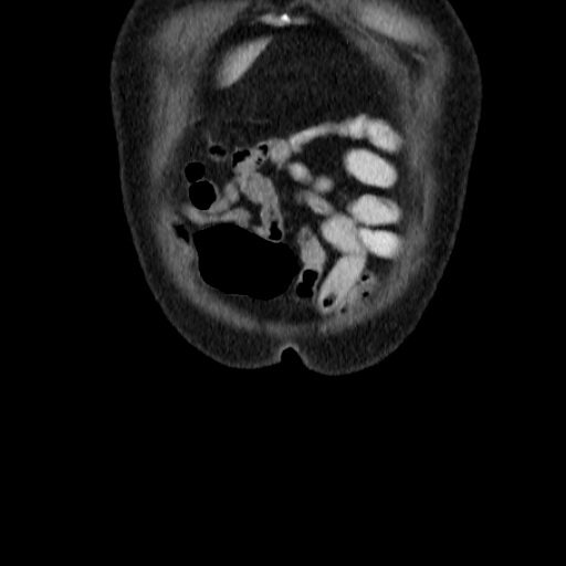 File:Colon cancer with duodenal invasion (Radiopaedia 16278-15958 B 4).jpg