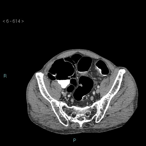 File:Colonic cancer (ultrasound and TC imaging) (Radiopaedia 50346-55713 A 107).jpg
