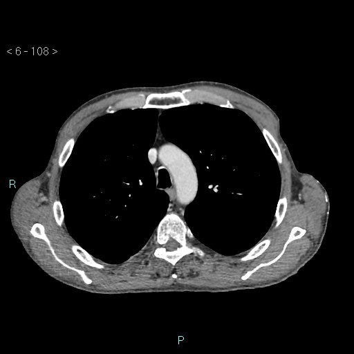 Colonic cancer (ultrasound and TC imaging) (Radiopaedia 50346-55713 B 108).jpg