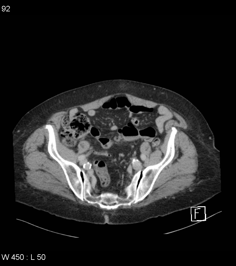 Colonic diverticular hemorrhage (Radiopaedia 52561-58475 C 85).jpg