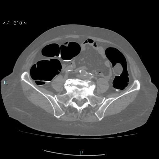 Colonic lipomas (Radiopaedia 49137-54244 Axial bone window 138).jpg