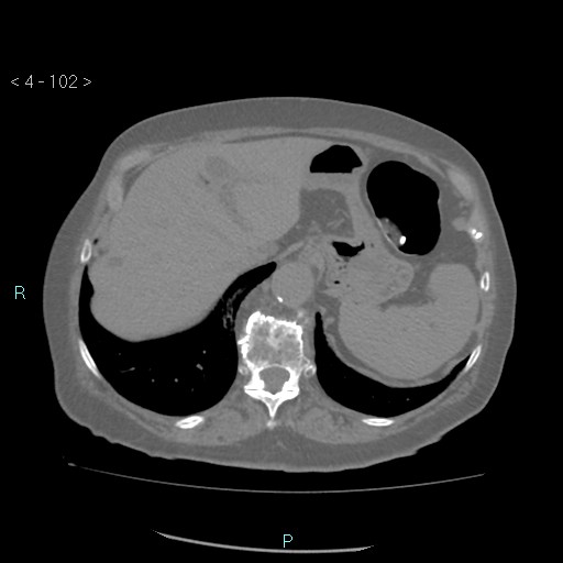 Colonic lipomas (Radiopaedia 49137-54244 Axial bone window 46).jpg
