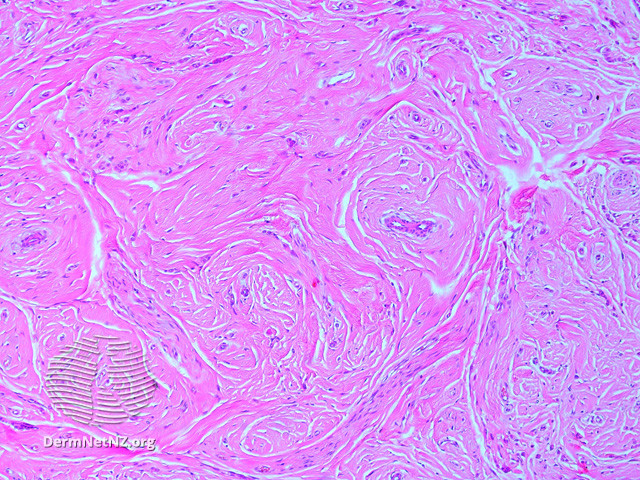 File:Figure 1 (DermNet NZ pathology-e-angiomyofibroblastoma-figure-1).jpg