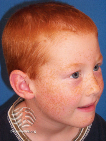 File:Freckles (DermNet NZ lesions-freckle2).jpg