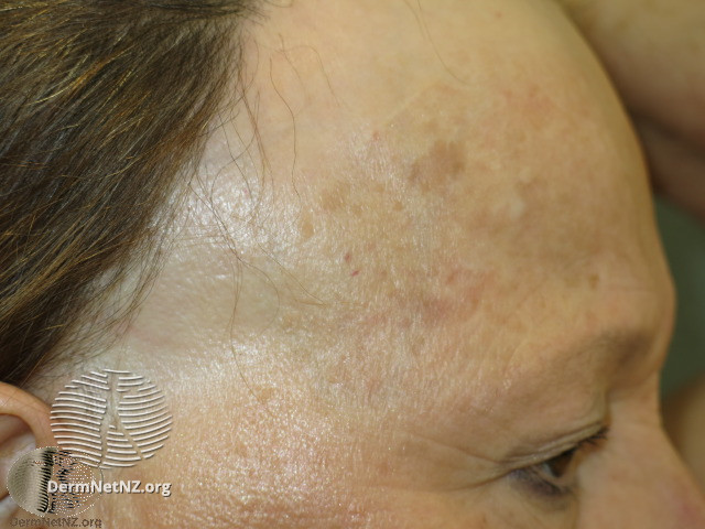 File:Graham Little syndrome. Scarring alopecia of anterior scalp (DermNet NZ hair-nails-sweat-graham-little-1).jpg
