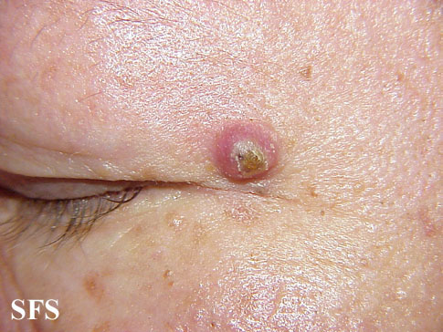 File:Keratoacanthoma (Dermatology Atlas 19).jpg