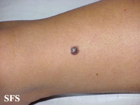 File:Melanoma (Dermatology Atlas 13).jpg