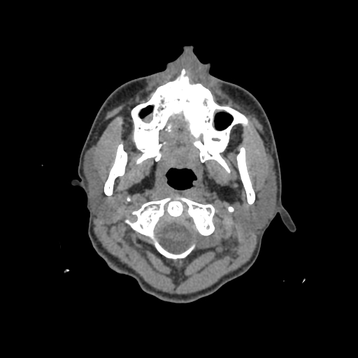 Nasal pyogenic granuloma (lobular capillary hemangioma) (Radiopaedia 85536-101244 Axial non-contrast 3).jpg