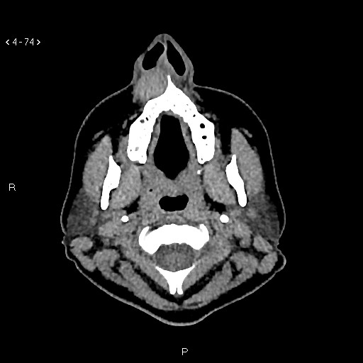 File:Nasolabial cyst (Radiopaedia 75125-86194 Axial non-contrast 36).jpg