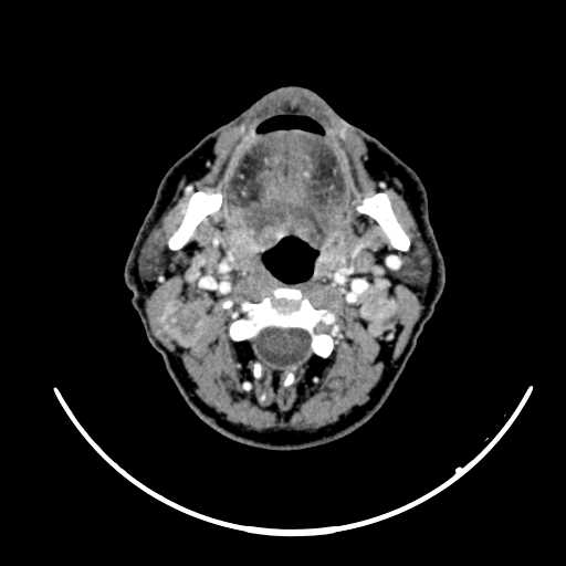 File:Nasopharyngeal carcinoma - infiltrating the clivus (Radiopaedia 62583-70875 Axial Post contrast 32).jpg