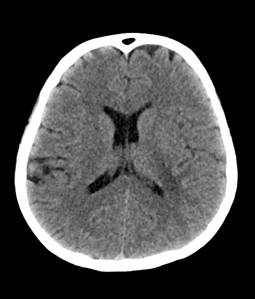 File:Nasopharyngeal carcinoma with cerebral abscess (Radiopaedia 43018-46275 Axial non-contrast 31).png