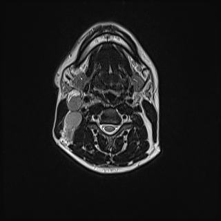 File:Nasopharyngeal carcinoma with perineural spread (Radiopaedia 55030-61380 Axial T2 49).jpg
