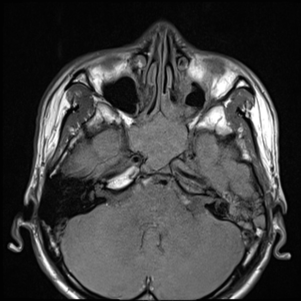 Nasopharyngeal carcinoma with skull base invasion (Radiopaedia 53415-59485 Axial T1 21).jpg