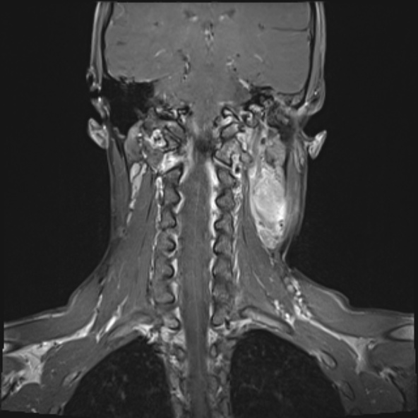 Nasopharyngeal carcinoma with skull base invasion (Radiopaedia 53415-59485 E 10).jpg