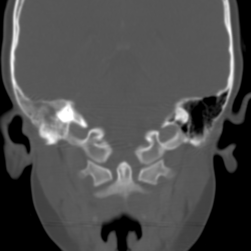 File:Nasopharyngeal rhabdomyosarcoma (Radiopaedia 23417-23491 Coronal bone window 9).jpg