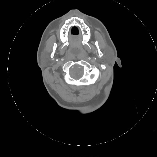 Neck CT angiogram (intraosseous vascular access) (Radiopaedia 55481-61945 B 244).jpg